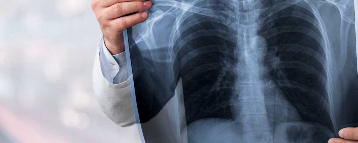 Source: https://www.banyantreatmentcenter.com/2022/03/02/alcoholic-lung-disease/