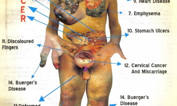 A smoker’s body showing the effects of smoking. / Illustration: Pan African Health Organization.