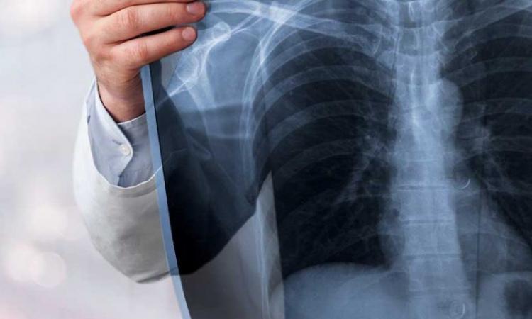 Source: https://www.banyantreatmentcenter.com/2022/03/02/alcoholic-lung-disease/